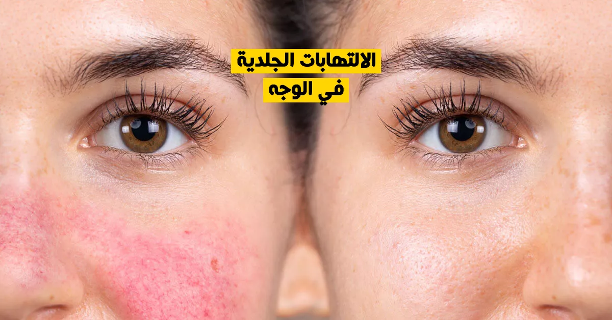 الالتهابات الجلدية في الوجه